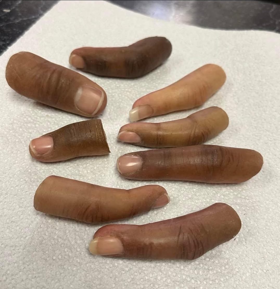 customised Finger Prosthetic
