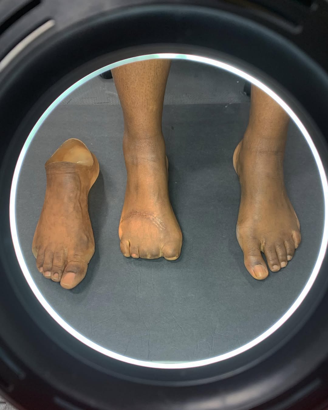 customised foot prosthesis